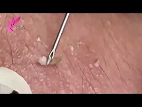Most Extreme Blackhead & Whitehead Extractions Ever Filmed!