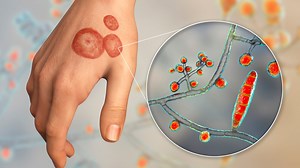 CDC on guard over deadly fungus spreading throughout the US