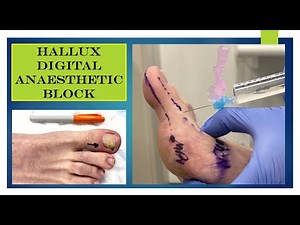 An overview of hallux digital anaesthesia
