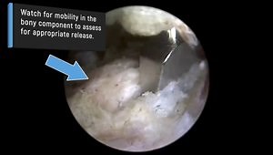 Hip Arthroscopy Os Acetabuli or Loose Body Removal