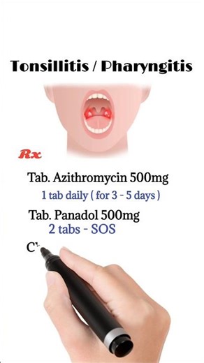 tonsillitis treatment | pharyngitis treatment