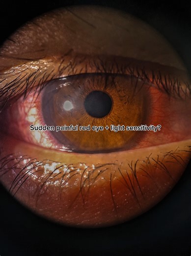 Understanding Acute Anterior Uveitis Symptoms and Care