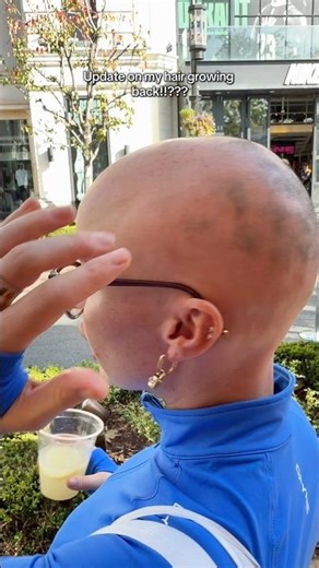 Filmed by my amazing boyfriend if you couldn’t tell by the 10/10 quality 🤣🫶🏼 #hairgrowth #bald ￼