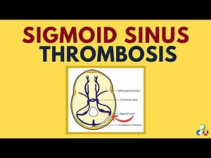 Sigmoid Sinus Thrombosis | Lateral Sinus Thrombosis (Thrombophlebitis)