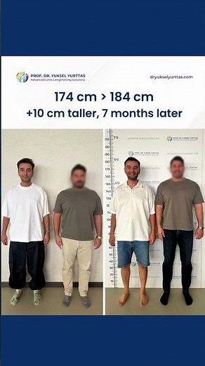 174 cm to 184 cm - 7 Months After Limb Lengthening Surgery #limblengthening