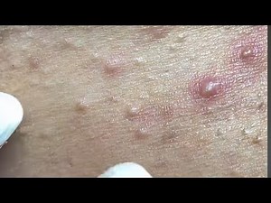Relaxing Acne Cleansing with LinhMyDang #614