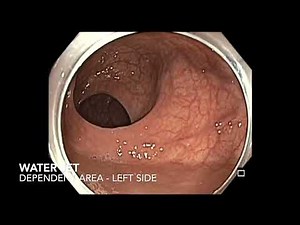 Colon-Colonoscopy-Rectum-Defining anterior wall