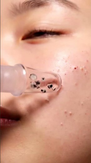 Giant Blackhead POP — So Satisfying to Watch