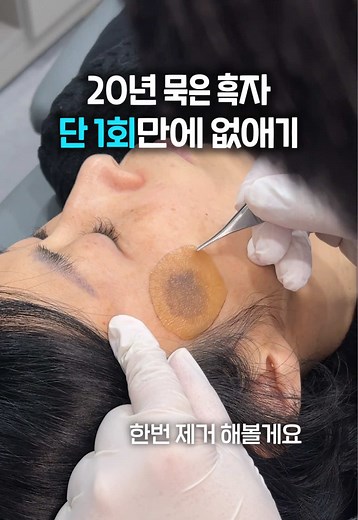 흑자 제거하기: 20년 묵은 흑자를 없애는 방법