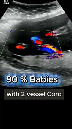 Two vessel cord: what this rare pregnancy finding means ? #ultrasound #pregnancy #baby