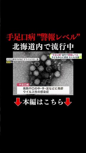 👆本編はこちら👆手足にブツブツ 痛みも… 各地で『手足口病』が流行し警報レベルに…発熱や喉の痛みの後に"手足に発疹" 幼い子どもだけではなく【大人も注意が必要】 北海道