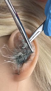 904K views · 2.2K reactions | Strange material removed from ear This original video was produced by Rick Lax and Alex Z. | Big-Time Amusement | Facebook