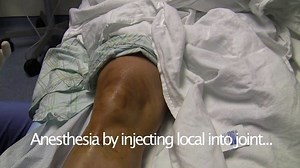 Intra-articular Knee Block Video