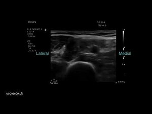 Ultrasound Guided Median Nerve Block (elbow level)