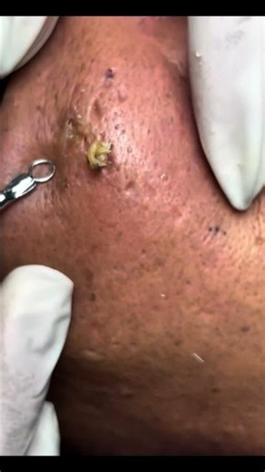 Satisfying Blackhead Extraction 🤯 | So Satisfying!