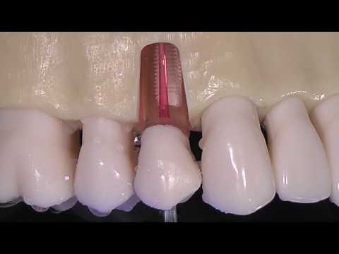 Endodontic tips ACTEON