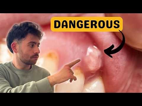 How To Know If You REALLY need a ROOT CANAL?