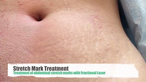 Laser Therapy Treatment for Stretch Marks