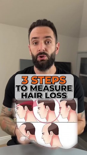 How to Measure Hair Loss: Assessing Your Stage in 3 Easy Steps