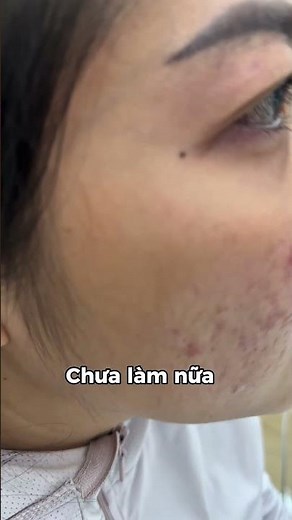 Chọn sai cách trị sẹo rỗ, sẹo lồi lõm thâm đỏ nặng khó điều trị lại và mất nhiều thơi gian phục hồi