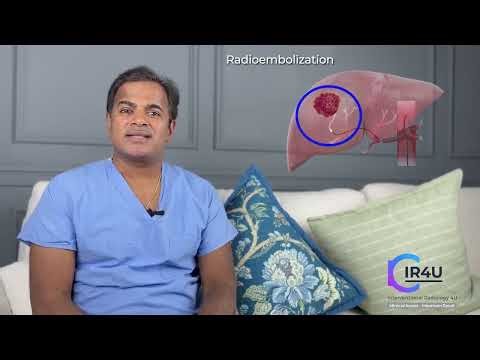 Advanced Liver Cancers: Y90 Radioembolization (TARE)
