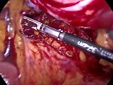 Laparoscopic Rectosigmoid Resection • Video • MEDtube.net