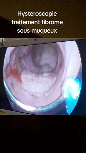 Traitement des fibromes sous muqueux par hysteroscopie #sante #gynecology