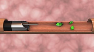 Urétéroscopie : en quoi consiste cette technique d’exploration des voies urinaires ?