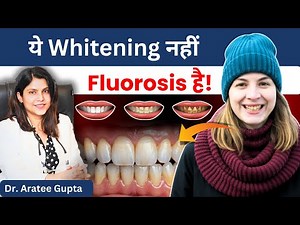 Fluorosis Explained: Causes, Prevention & Treatment for White Teeth Spots‪@smilestudiovns‬