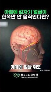 Bell's Palsy: What if one side of your face suddenly stops moving in the morning? #Bell'sPalesis