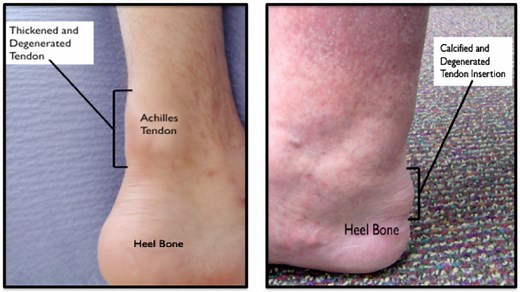 Achilles Tendonitis