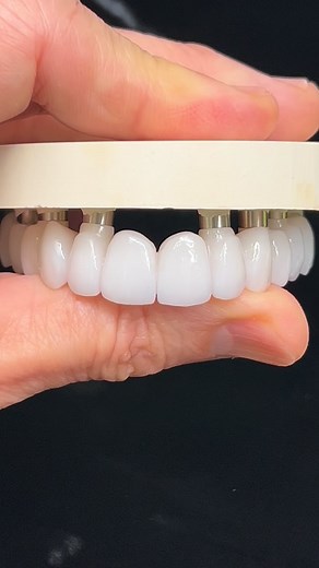 FP1 monolithic zirconia bridge, divided into 3 segments for precision and retrievability. Surface characterization and final esthetics finished with MiYO. Digital precision meets ceramic artistry. Dr. Dean “Godfather” McNeel Cad/Cam : Rufino Lira-Martinez CDT Special thanks to: @deanmcneel @ozarkpros @jensendental @whitepeaksusa #FullArchZirconia #FP1 #ZirconiaBridge #MonolithicRestoration #ImplantProsthesis #DigitalDentistry #MiYO #JensenDental #GreenState #EstheticDentistry #DentalLab #Ceramis