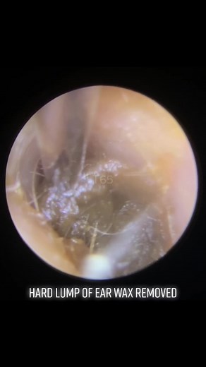 Effective Ear Wax Removal Techniques
