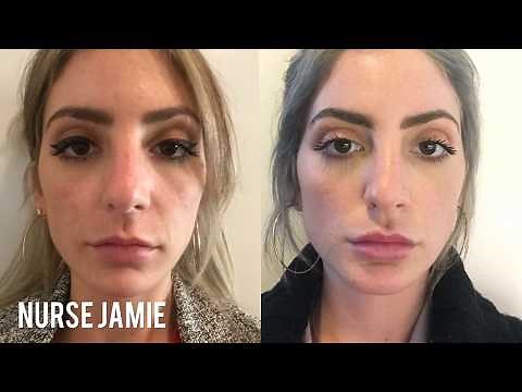 Before and After Micro Needling | Nurse Jamie