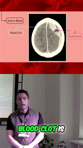 Is it an active bleed or a clot? Chris Reilly, MD (@docreilles) from ResusX:ReUnion explains.