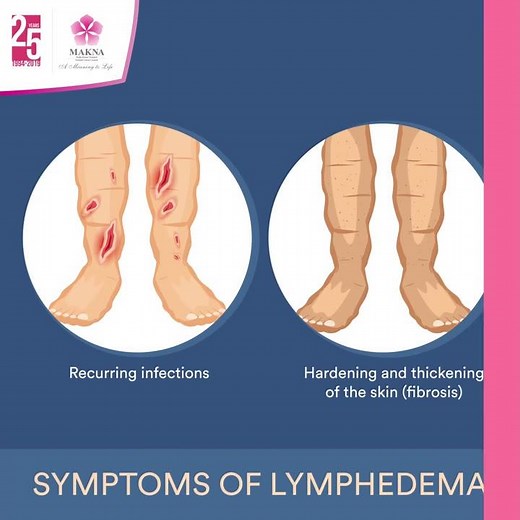 Symptoms of Lymphedema
