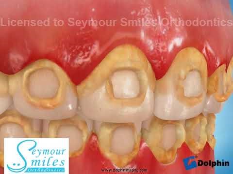 Decalcification (Orthodontics)