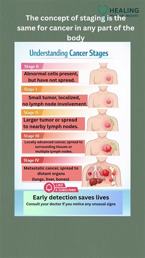 Stages Of Cancer| Cancer Staging: One Concept, All Body Parts |Dr Nuzhat #stageofcancer