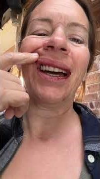 10 teeth extracted and immediate dentures placed #dentaltourism #dentures #bajacalifornia #ensenada