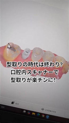 口腔内スキャナーで型取りが楽チンに！? #あらかわ歯科医院