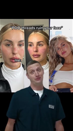 Pdo cheek lift has changed my life tbh #pdothreadlift #cheeklift