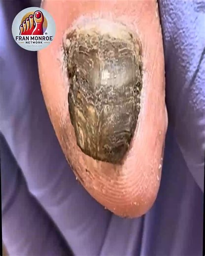 31K views · 231 reactions | Gentle Nail Tips for Damaged Nail Surfaces Without Cutting or Filing #HealthyNails #CleanNailsDaily #NailCareTips #ToenailRoutine | Fran Monroe | Facebook