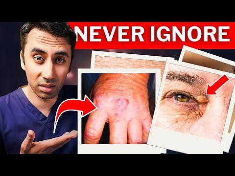 Doctor Explains 4 Skin Signs of High Cholesterol (Real Life Photos)