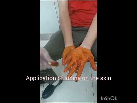Demo-25: The starch iodine test to mark points of hyperhidrosis.