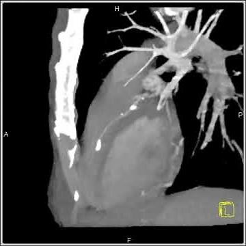 Vascular: Diseased LAD: 3D and 4D mapping of the coronary CT angiogram(2 of 2)