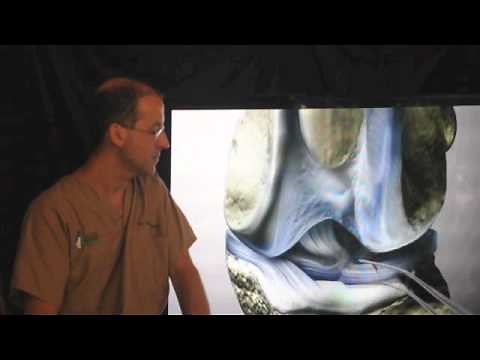 Extracapsular surgical repair of the CCL injury in the dog and cat.