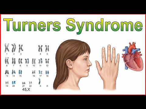 20. Turners Syndrome: Obstetrics & Gynecology