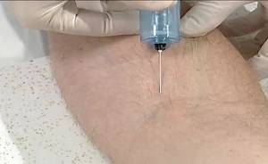 Retractable Phlebotomy Device