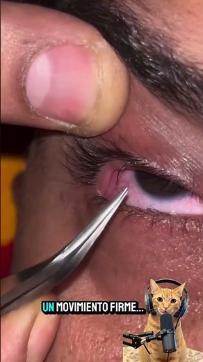 Ingrown eyelash 😳 Removal with tweezers and instant relief 👁️✨