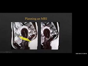 MR Imaging in Ca Cervix